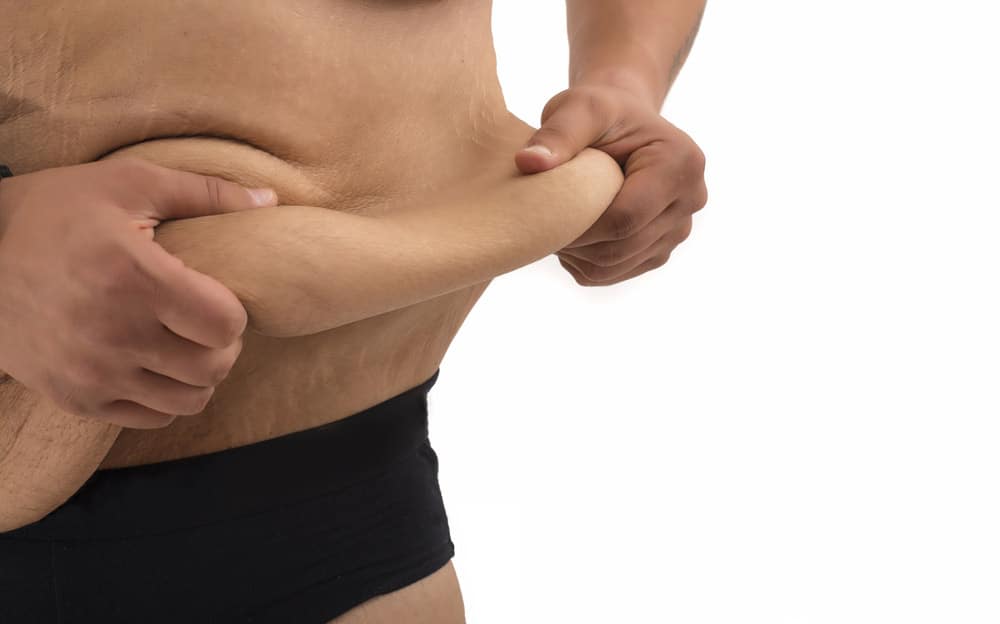 Liposucción vis Abdominoplastía: ¿cuál logra una mejor cintura