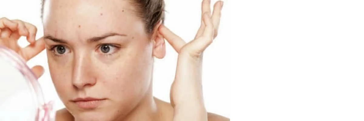 Otoplastia sin cirugía