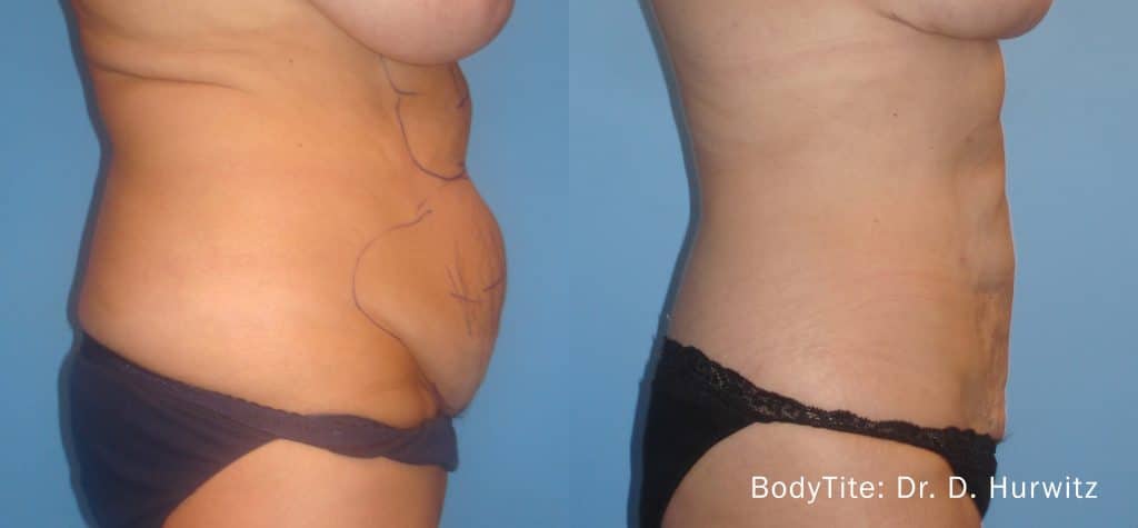 Antes y despues tratamiento abdomen con Bodytite