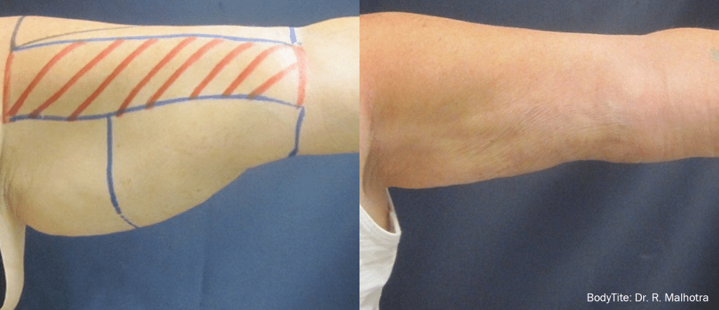 Antes y despues tratamiento brazos con Bodytite