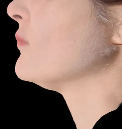 Antes y después Accutite de InMode