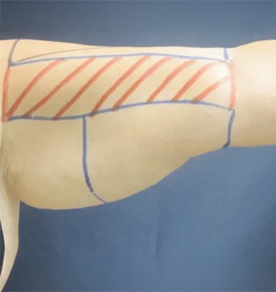 Antes y después Bodytite InMode