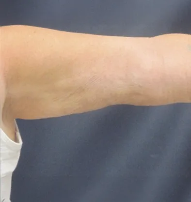 Antes y después Bodytite InMode