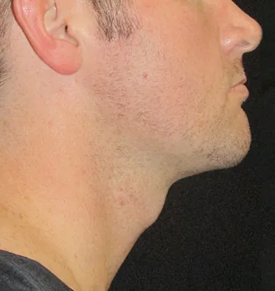 Antes y después Facetite InMode