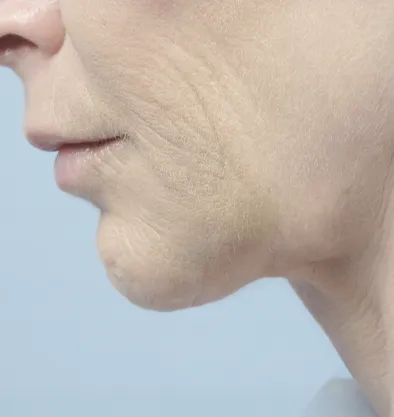 Antes y después Facetite InMode