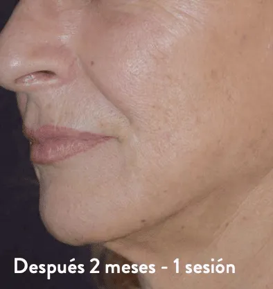 Antes y después Embrace RF InMode