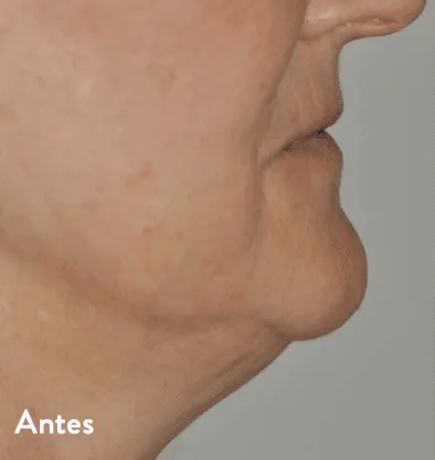 Antes y después Embrace RF InMode