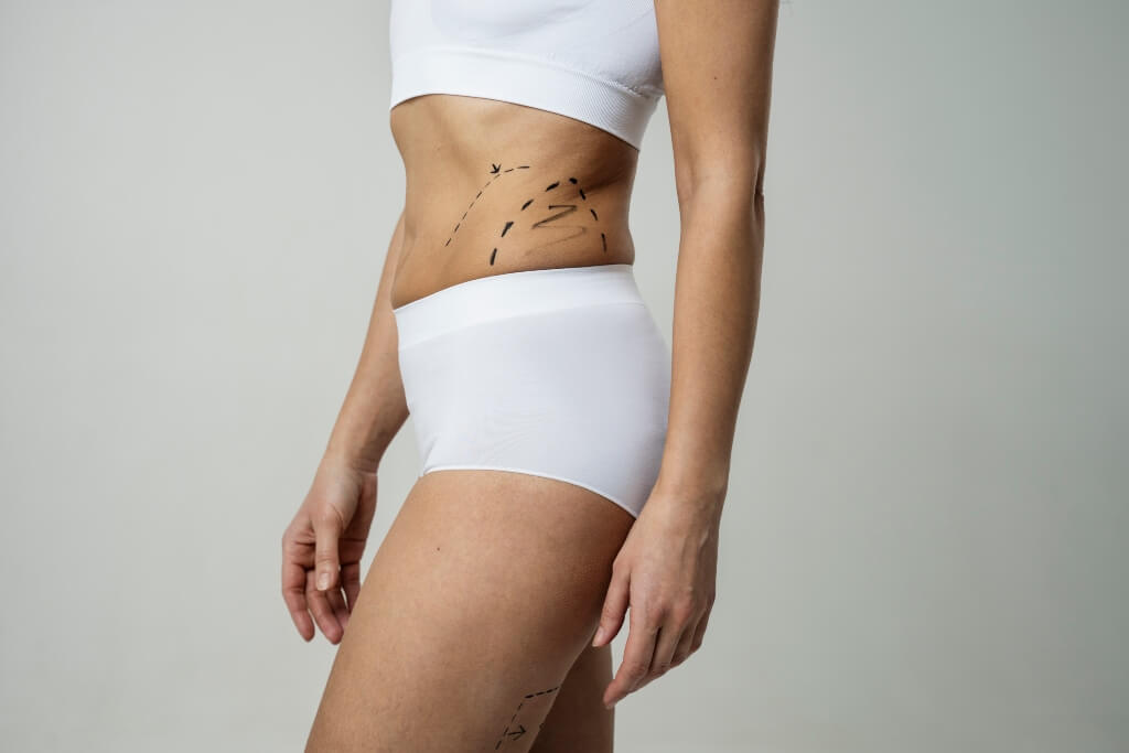¿Qué es la lipoescultura?