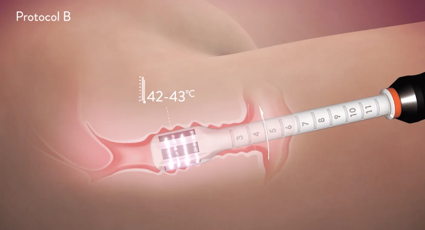 Protocolo B Forma V de Inmode Protocolo B Forma V de Inmode