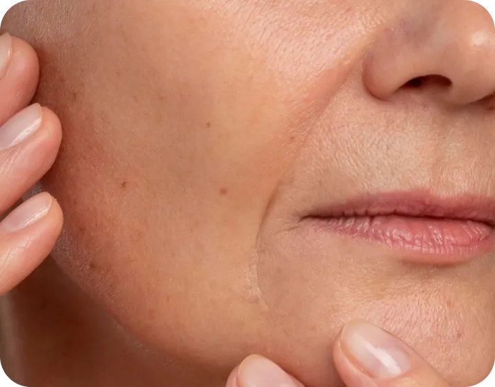 Radiofrecuencia facial lifting sin cicatrices