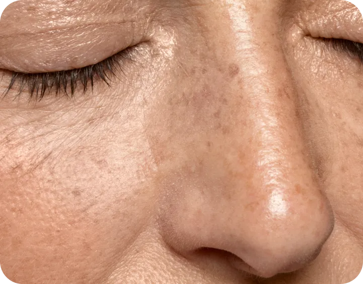 Renovacion subdermica Morpheus 8