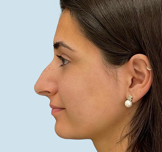 Caso rinoplastia antes