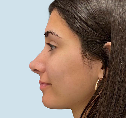 Caso rinoplastia después