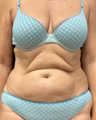 Abdominoplastia Barcelona