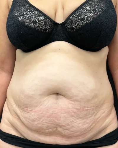 Abdominoplastia Barcelona