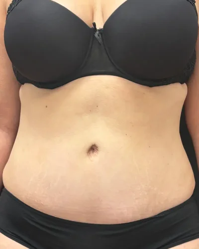 Abdominoplastia Barcelona