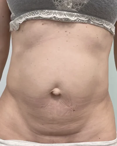 Abdominoplastia Barcelona