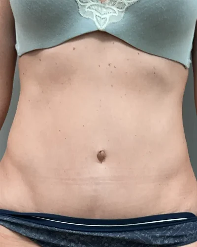 Abdominoplastia Barcelona