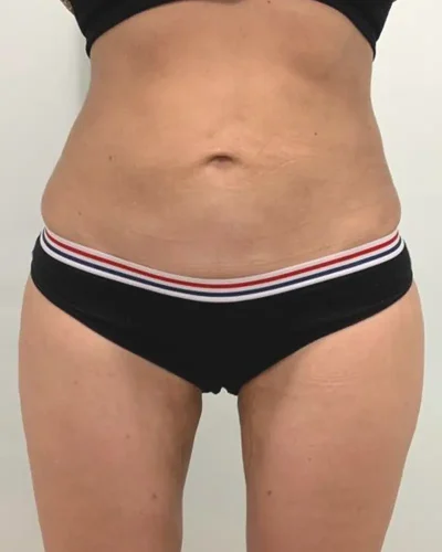 liposucción Barcelona