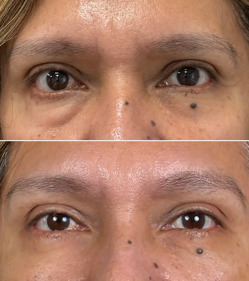 Blefaroplastia Barcelona