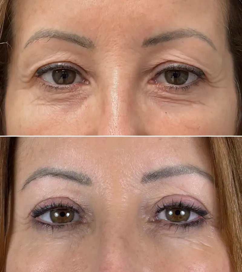 Blefaroplastia Barcelona