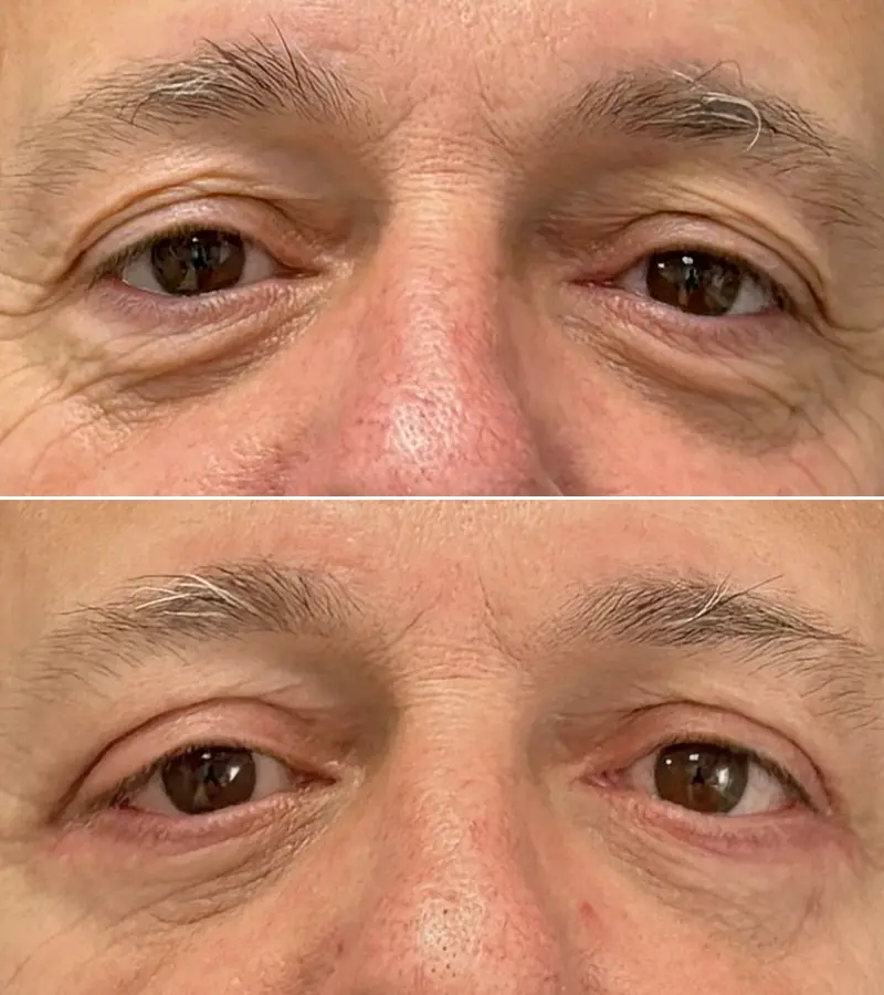 Blefaroplastia Barcelona