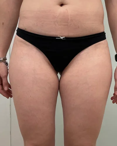 liposucción Barcelona